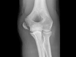 Supracondylar fractures of the humerus in children. Medial Epicondylar Fractures Pediatric Pediatrics Orthobullets
