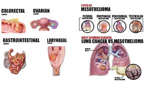 This type of study is exciting for patients with challenging cancers like mesothelioma. What Kind Of Cancers Can Asbestos Exposure Cause Elg Law