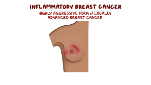 Image result for Inflammatory breast cancer