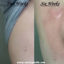 How I Held My Skin Together During Radiation Therapy Rustic Yet Chic Radiation Skin Care Radiation Therapy Cancer Radiation