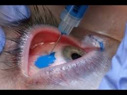 Tattooing the eyes black can give that cartoon look if you have a dark iris or put in dark contact lenses to go with it. Eyeball Tattoo Youtube