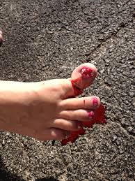 I got a weird shoe thing which. My Big Broken Toe Photos For Friends Pink Gis Painted Nails