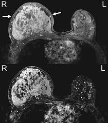 Image result for Inflammatory breast cancer