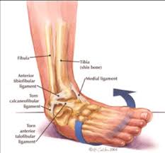 Second degree ankle sprains fall between these two and denote a partial ripping of the ligament. How To Fix A Sprained Ankle Ankle Physio Highett