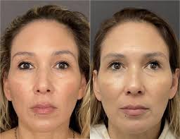 Laser Skin Resurfacing Santa Barbara, CA