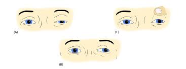 Image result for Pupillary Paralysis