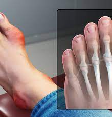 De cele mai multe ori doar o singura articulatie este afectata. Scapa De Guta In Mod Natural Retete Din Pedicuta