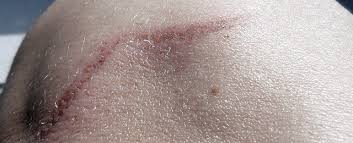 Tattoos take time to heal, but if you're having strange symptoms, you may have an infection or an allergy to tattoo ink. Can You Get A Tattoo Over A Scar Inking Wounded Skin Tissue