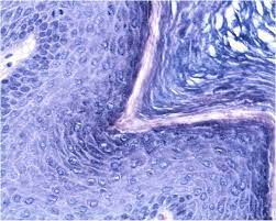 Condyloma Acuminatum Genital Warts Dermatology Advisor