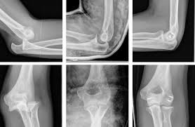 Image result for Elbow Dislocation