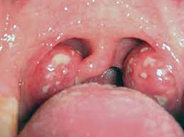 In some cases, you must visit a doctor as certain bacterial infections that affect tonsils must require antibiotic treatment. Tonsillitis Symptoms Pictures Causes And Treatment