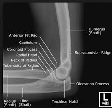 Image result for Elbow Dislocation