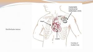 Você sabia que existiam outras classificações deste equipamento a. Desfibrilacion Cardioversion Ppt Descargar