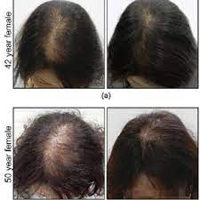 Just like our bodies change with age, most women notice some hair thinning as they get older. Pdf Combination Therapy To Treat Asian Female Pattern Hair Loss