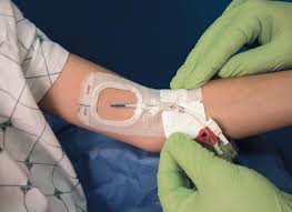 Image result for Difficult Intravenous Access in Children