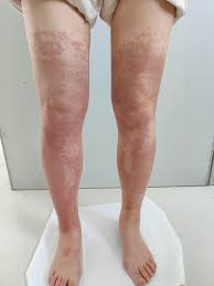 Image result for contact dermatitis