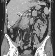 Maybe you would like to learn more about one of these? Acute Appendicitis Presenting With Right Upper Quadrant Pain Consultant360