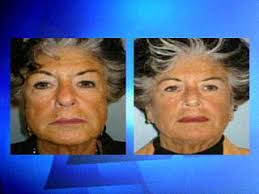 Liquid Facelifts Promise To Improve Looks Without Surgery