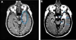 Mri showing extensive necrotizing sequelae. Mri Diagnosis Of Herpes Simplex Encephalitis In An Elderly Man With Nonspecific Symptoms Sciencedirect