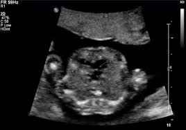 Cardiovascular System Hypoplastic Left Heart Embryology