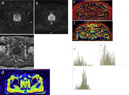 Of course, your specialist is the main person whose advice you should follow but it doesn't do anyone harm. Differentiation Of Prostate Cancer Lesions In The Transition Zone By Diffusion Weighted Mri European Journal Of Radiology Open