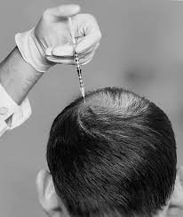 Hair fall treatment by saya skin and hair clinic. Prp Hair Treatment Its Cost In Delhi Prp Therapy For Hair Loss Ak Clinics