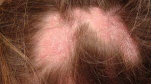 Image result for white scabs on the head in children