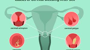 But menopause can also happen if your ovaries stop working due to some cervical cancer treatments. Postcoital Bleeding Why You May Bleed After Sex