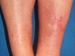 Your doctor or endocrinologist will recommend the best treatment for you and your particular case of graves' disease. Hyperthyroidism Dermnet Nz