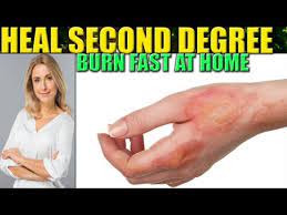 How To Heal A Burn Fast At Home - Naijagists.com - Proudly Nigerian Diy  Motivation & Information Blog