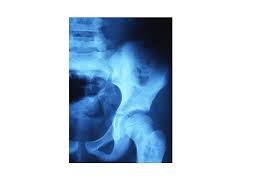 Figura 4 Paciente Diagnosticada De Sindrome De Mc Cune Albright Con Pubertad Precoz Periferica En La Que Se Observan Lesiones De Esclerosis En El Estudio Oseo