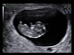 A dating scan is a method that is used to reliably assess the age of a foetus with a maximum error of 3 to 5 days. Dating Scans Ultrasound Plus