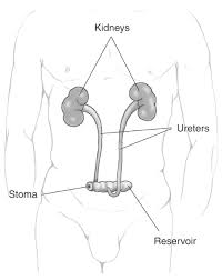 The segment is resected from the intestine with nerves and blood supply intact. An Ileal Conduit Urinary Diversion With Labels Media Asset Niddk