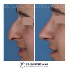 Check spelling or type a new query. Male Rhinoplasty Before And After Photos