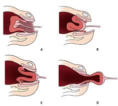 Image result for Uterine Inversion