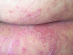 Image result for itchy skin rectum