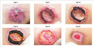 Pictures of brown recluse spider bite first nine days symptoms of a brown recluse bug bite include severe pain at the site of the bite that develops. Girl S Brown Recluse Spider Bite Turns Into Open Wound Live Science
