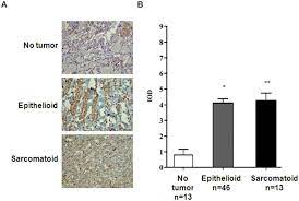 Mesothelioma is a tumor of mesothelium, a tissue that lines lungs and other organs. Expression Of Sphk1 In Malignant Pleural Mesothelioma Tumor Tissues Download Scientific Diagram