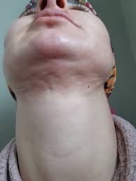 Vaser Liposuction Ile Gidi Aldirma Kadinlar Kulubu