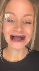 How My Dentures Work 🦷