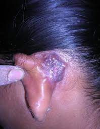 It is the most common mycobacterium tuberculosis skin infection. Https Oatext Com Pdf God 1 114 Pdf