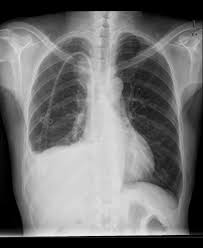 The internal mammary artery has been the graft of choice since the 1980s, after widespread angiographic and clinical demonstrations of its photo 1: Iatrogenic Internal Mammary Artery Pseudoaneurysm Radiology Case Radiopaedia Org