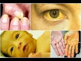 Penyakit yang dikenal juga sebagai penyakit kuning (jaundice) ini penularannya berbeda dengan vhb dan vhc, yakni melalui makanan dan minuman yang tercemar kotoran yang mengandung virus ini. Ternyata Ini Obat Tradisional Sakit Kuning Untuk Dewasa Dan Anak Youtube