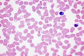 Unless it is diagnosed and treated promptly, it can be fatal. A New Way To Diagnose Malaria Mit News Massachusetts Institute Of Technology