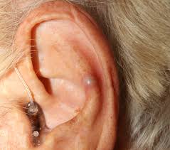 The doctor will ask about your recent medical history just to rule out any other causes for the bump on your ear. Epidermoid Cyst Infected Causes Symptoms Treatment