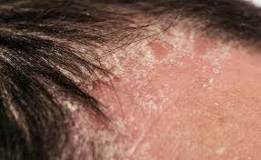 Image result for psoriasis