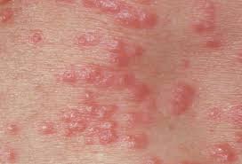 Image result for pubic lice symptoms