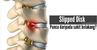 Namun, ambil tahu tentang tanda slip disk ini supaya kita dapat elak dari keadaan yang lebih bahaya. Masalah Slipped Disk Berpunca Sakit Belakang Azeniahmad Com