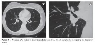 Your lungs or your digestive system, also american cancer society: Jornal Brasileiro De Pneumologia Tumor Carcinoide E Sequestro Pulmonar