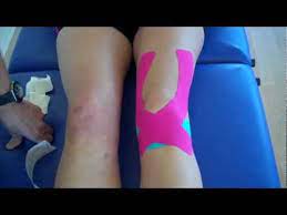 How To Apply Kinesiology Taping For Knee Pain Patella Tendonitis And Patella Femoral Pain Youtube
